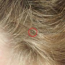 What Do Lice Eggs Look Like On Hair Published In Massify Online Magazine Health A Lot Of People Don T Know That Head Lic Lice Eggs Lice Eggs Look Like Louse