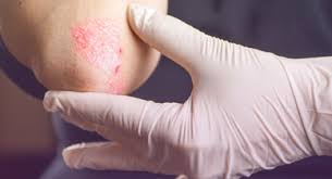 Type pain in my glans.so far two igg,igm blood test are negative and one more blood test the method is western blot but not sure it is the same which is done by university of washington hsv2 western. Psoriasis Vs Herpes What S The Difference