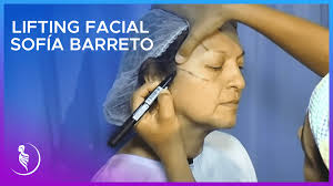 Lifting facial de Sofía Barreto