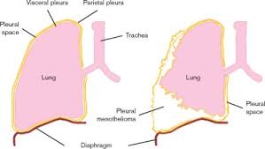 Malignant diffuse mesothelioma is the most common type ofmesothelioma, with a median survival ranging from 8.5 to 18 monthsafter diagnosis. Mesothelioma Thoracic Key