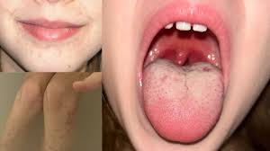 Image result for Scarlet Fever