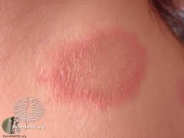 It might look skin coloured, waxy, like a scar or thickened area of skin that's very slowly getting bigger. Red Scaly Rash Here S Why You Need A Dermatologist To Diagnose You
