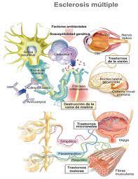 Con la esclerosis múltiple, el sistema inmunitario ataca la vaina protectora (mielina) que recubre las fibras nerviosas y causa problemas de comunicación entre el cerebro y el resto del cuerpo.con el tiempo, la enfermedad puede causar el deterioro o daño. Nuevas Perspectivas En El Tratamiento De La Esclerosis Multiple
