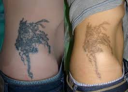 Wondering how to remove a tattoo naturally and painlessly? How To Quickly Remove A Tattoo At Home Can I Remove The Tattoo With Potassium Permanganate Iodine