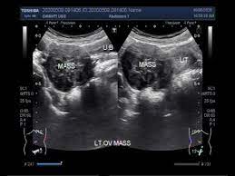 An ultrasound of the pelvis is usually the first test that is ordered to see if there is any problem with the ovaries or other pelvic organs. Ultrasound Video Showing An Ovarian Tumor Youtube