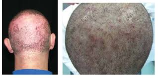 Image result for folliculitis symptoms