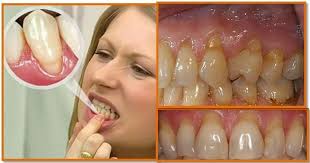 Gum disease can be treated :). Pin On Oil Pulling Coconut Oil