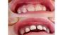 Dental Bridge