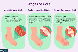 Image result for gout