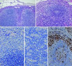 Maybe you would like to learn more about one of these? Infektiose Lymphadenitis Springerlink