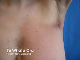 Image result for Radiation Dermatitis