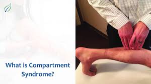 Image result for Compartment Syndrome