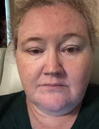 Has anyone experienced a drooping brow