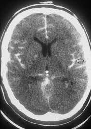 L'emorragia subaracnoidea (esa) è una grave condizione clinica in neurologia e neurochirurgia può essere causata da rottura di un aneurisma cerebrale, da fattori traumatici o, a volte, restare. Emorragia Subaracnoidea Esa Malattie Neurologiche Manuali Msd Edizione Professionisti