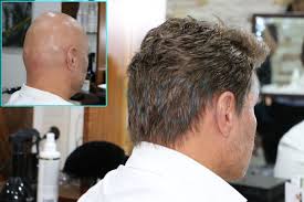 Alopeside Sac Dokulmesine Cozum Folligraft Sac Sac Dokulmesi