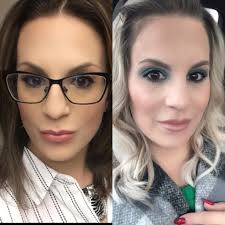 Hair growth results from hair spritz and vitamin D treatment