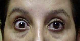Medical Management Of Thyroid Eye Disease Sciencedirect