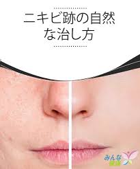 ニキビ跡の自然な治し方 若い頃 不快で厄介なニキビに皆 悩まされたのではないでしょうか 永久的に肌にダメージを与え 見苦しい跡を残してしまい 耐え難く不快に感じている人もいるのではないでしょうか ニキビ跡とは ニキビの炎症過程によって形成されてしまった