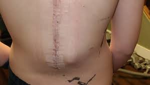 Fundraiser for Larry Freeman by Lisa Hilts : The Back of a 14 Year Old Boy