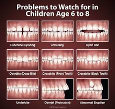 This is when the upper jaw ends up being larger than the lower and a problem arises. What Is An Overbite Or Underbite West Bowmanville Family Dental