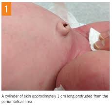 Image result for Umbilicus botryoides