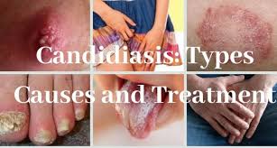In fact, yeast infection pimples can form here because of sweat and heat. Ayurvedic Herbal Treatment Of Candida Yeast Infection In Adelaide Sa