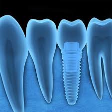 In the uae, the cost could vary from 4000 aed to 12000 aed depending on the emirate and the kind of practice you. Dental Implants Low Cost Dental Implants In South Delhi India