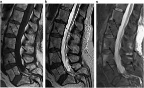 By contrast, a cross sectional mri view at l5/s1 in a patient without cauda equina syndrome showing an unobstructed vertebral canal (arrows. Mri Of Inflammatory Spondyloarthropathy Following Traumatic Cauda Equina Syndrome Spinal Cord