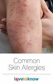 Common Skin Allergies Lovetoknow Skin Allergies Allergic Reaction On Skin Allergic Dermatitis