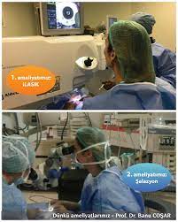 Cocuklarda Salazyon Eriskinlerde Oldugu Gibi Lokal Anestezi Ile Yapilamiyor Maske Anestezisi Gerekiyor Kontaktlens Contactlens Ilasik Serum Bilgi Ikiz