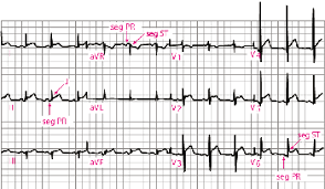 Gli enzimi cardiaci possono essere anormali nei pazienti con miocardite acuta. Pericardite Disturbi Dell Apparato Cardiovascolare Manuali Msd Edizione Professionisti