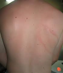 Savesave eritem polimorf for later. Eritemul Migrator Mivaderm Cabinet Dermatologie Dr Virginia ChiÈu