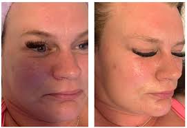 Another bb glow done today for this beauty, this was her first bb glow  ever, these are her before and immediately after pics, she will continue  seeing more results in the next
