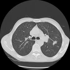(this nodule can be mistaken for lung cancer or tuberculosis). Tuberculosis Mimicking Lung Cancer Sciencedirect