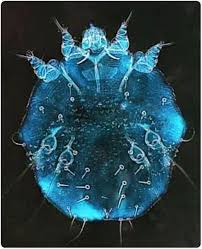 Image result for scabies human children