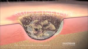We did not find results for: Surgical Debridement Youtube