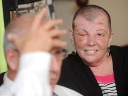 Sharon Budd talks about long road back from rock-throwing injury