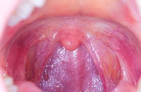 Throat Cancer S Link To Oral Sex What You Should Know Health Essentials From Cleveland Clinic