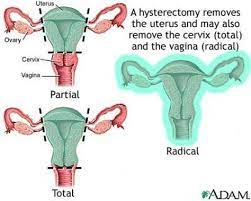Overview Of Hysterectomy Hysterectomy Hysterectomy For Endometriosis Hysterectomy Recovery