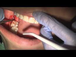 How To Pull A Wisdom Tooth Fully Impacted Wisdom Teeth Wisdom Teeth Removal Impacted Wisdom Teeth