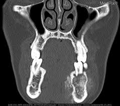 Osteosarcoma of jaw bones is a medullary type of osteosarcoma. Medpix Case Ostoegenic Sarcoma Jaw Osteosarcoma