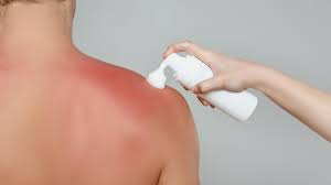 Image result for Sunburn