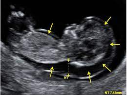 The nuchal translucency scan or nt scan measures the clear (translucent) space in the tissue at the back of your child's neck. Increased Fetal Nuchal Translucency Thickness And Normal Karyotype Prenatal And Postnatal Outcome Intechopen