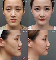 Before After Facial Contouring Facial Contouring Plastic Surgery Chin Reduction Surgery