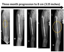 Limb Lengthening An Overview By S Robert Rozbruch Hss