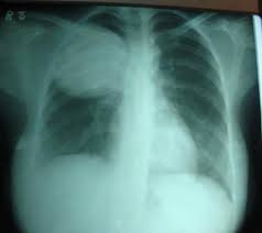 The precise pathophysiology of fluid accumulation varies according to underlying aetiologies. A Well Defined Rounded Opacity In Right Upper Lung Zone Appears To Be Of Fluid Density No Air Bronchogr Seen Ascend Radiology Imaging Radiology Tech Radiology