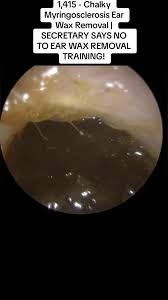 Image result for Myringosclerosis