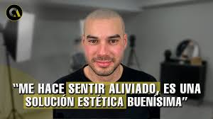 Oscar Arango Micropigmentación capilar