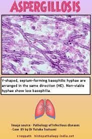 Apergillosis is a disease of the respiratory system caused by several aspergillus spp. Pathology Of Aspergillosis Pathology Infectious Disease Chronic Obstructive Pulmonary Disease