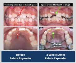 How long will it take me to learn to drive? Phase 1 Braces What It Means For Your Child Prosmiles Orthodontics